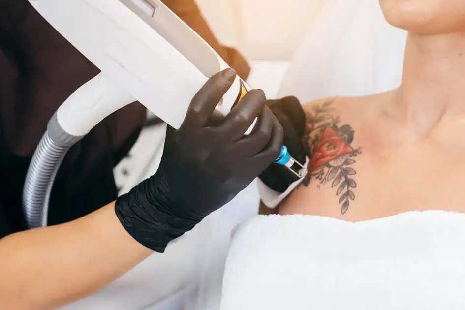 Laser Tattoo Removal by Instinct Holistic Medical Spa in BOZEMAN, MT