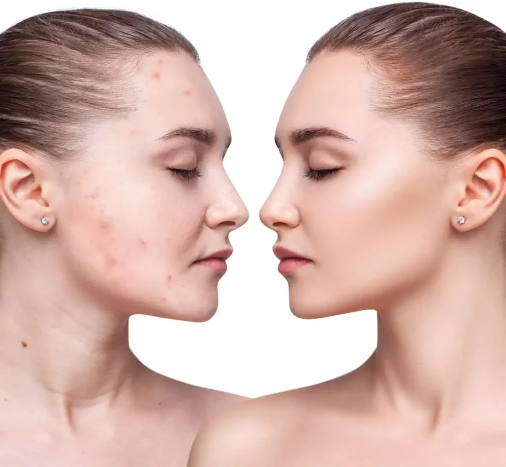 AviClear Acne Treatment by Instinct Holistic Medical Spa in Bozeman MT
