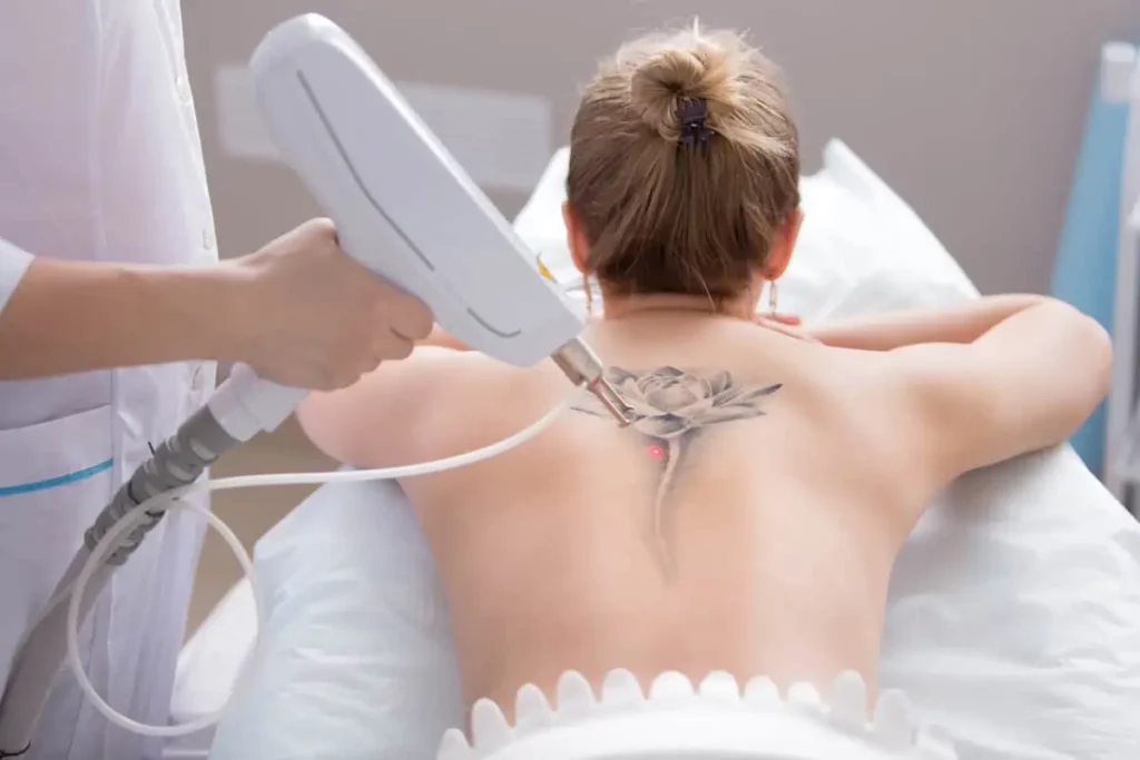 laser tattoo removal by instinctbozeman in bozeman