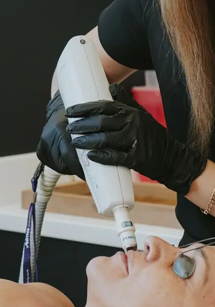 Lip treatment using a laser device - ClearLift Lip Treatment
